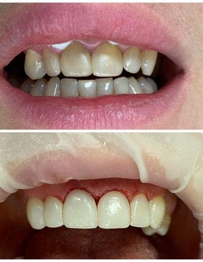 Estetinis Plombavimas Vilniuje Darbai 4