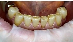 Nekariozinės dantų pažaidos