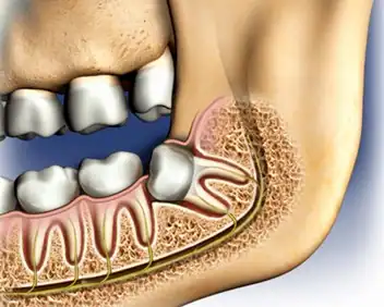 protiniu dantu salinimas rovimas