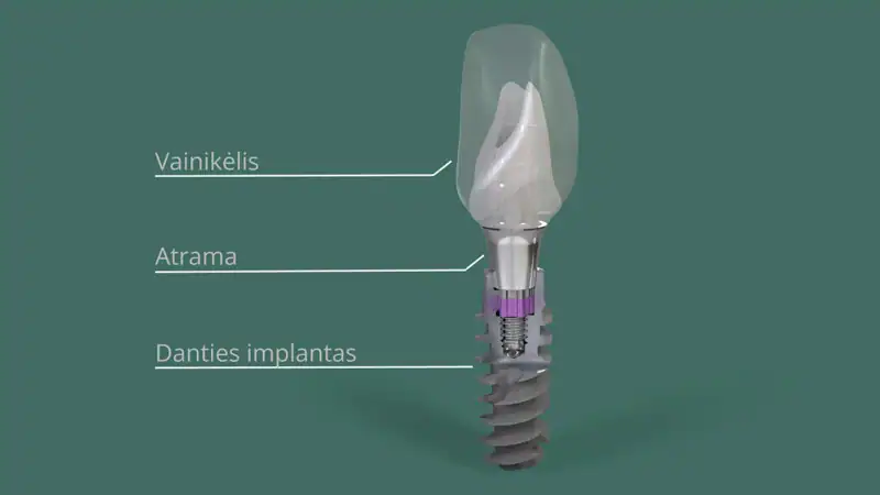 is ko susideda Dantu impnatas odontologijos klinika City-Dent