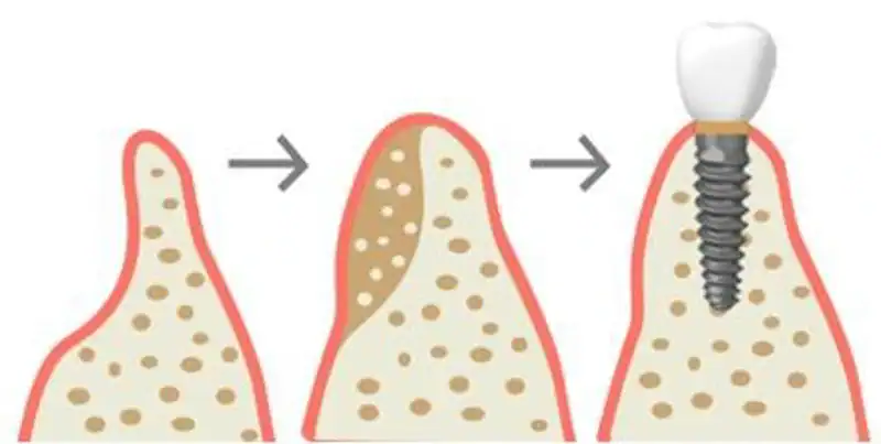 kaulo priauginimas implantavimui City-Dent